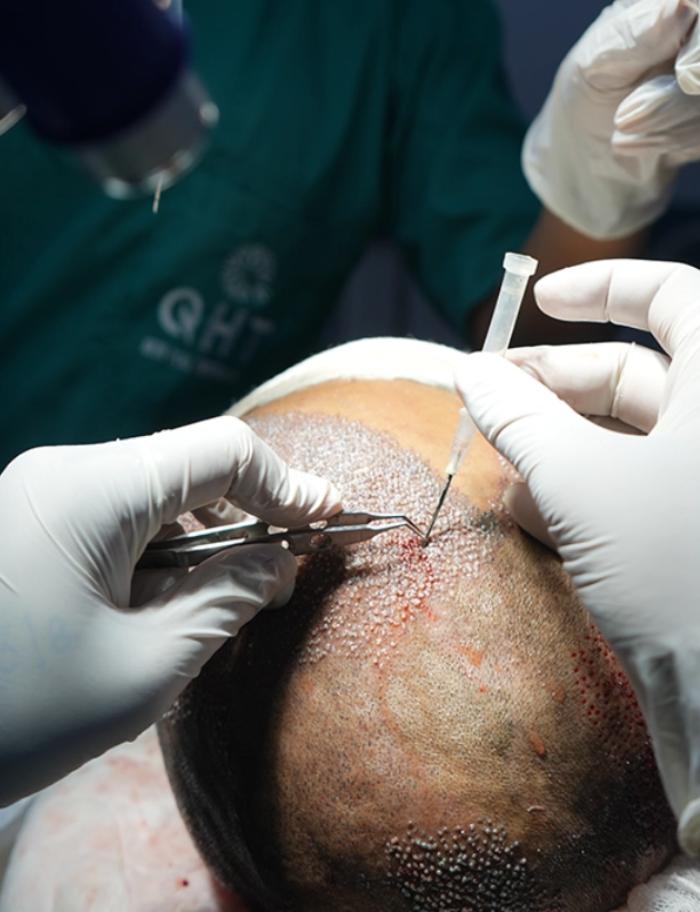 Hair transplant